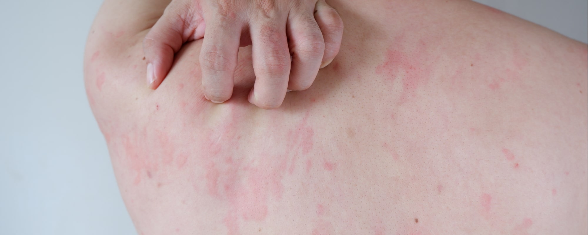 irritazione cutanea