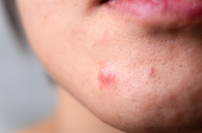 Acne da mascherina
