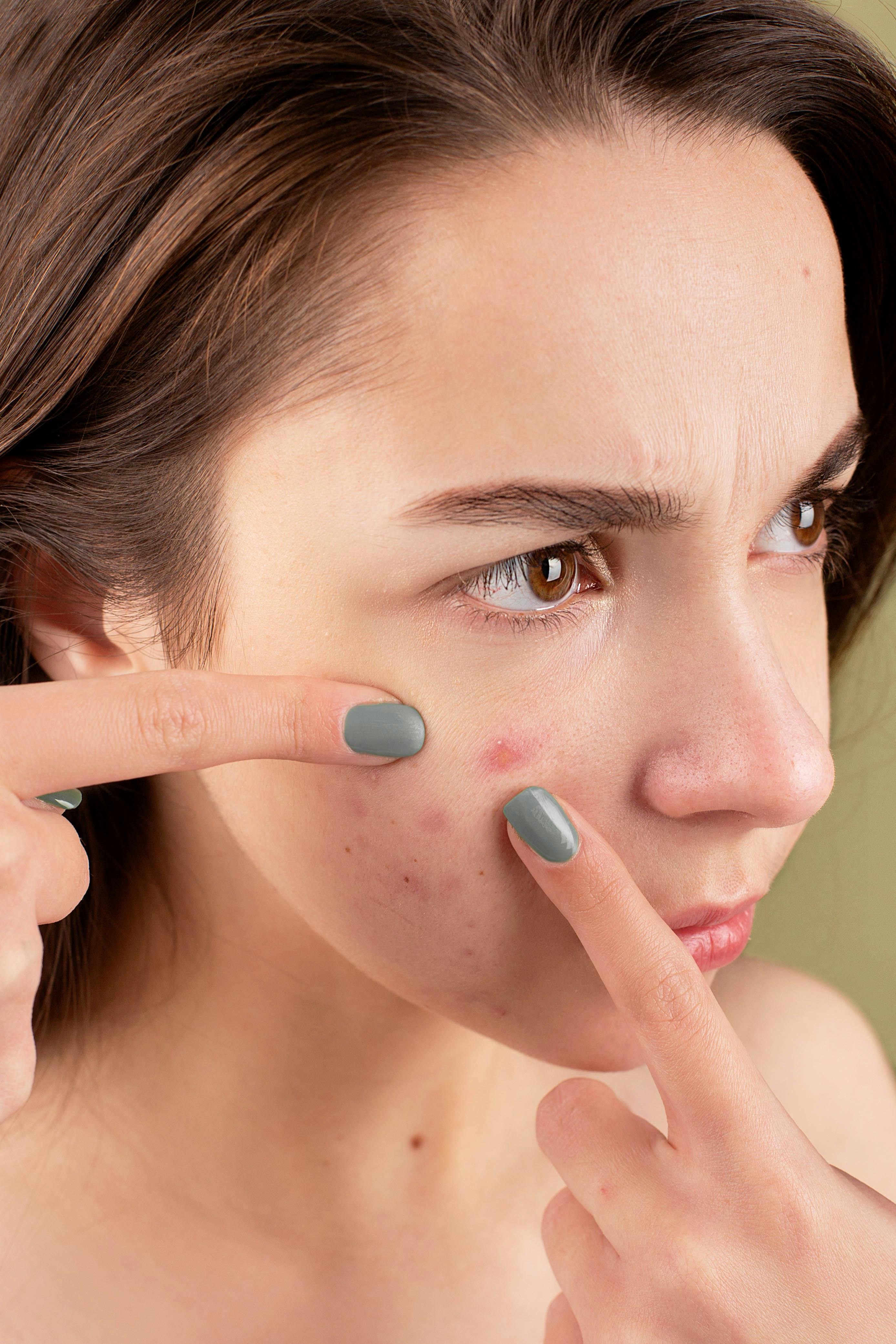 acne brufol