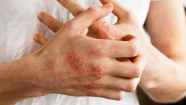 dermatite da contatto irritativa