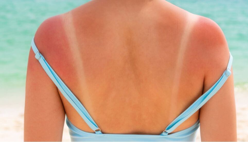 sunburn challenge