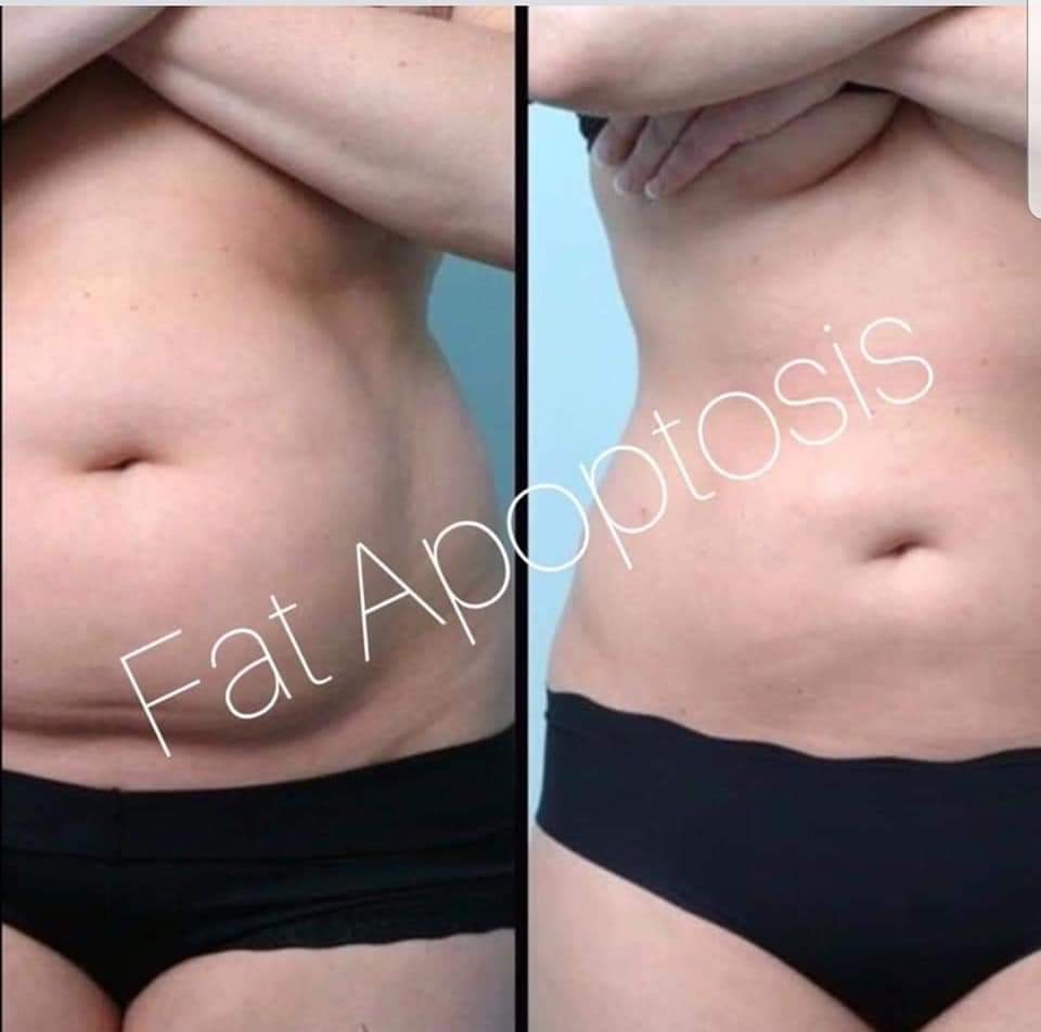 fat apoptosis addome