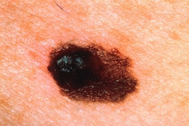 melanoma