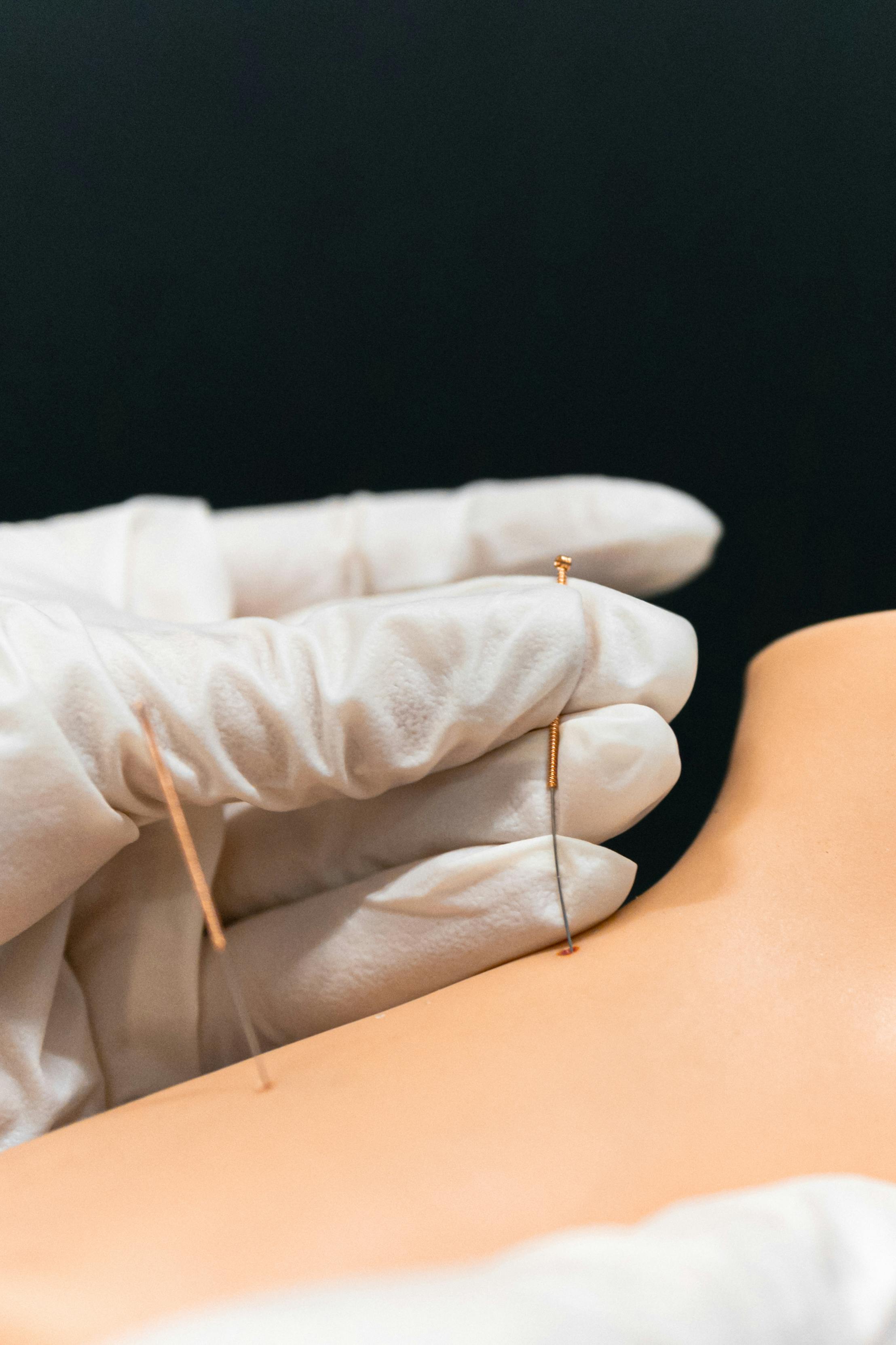 agopuntura e mesoterapia