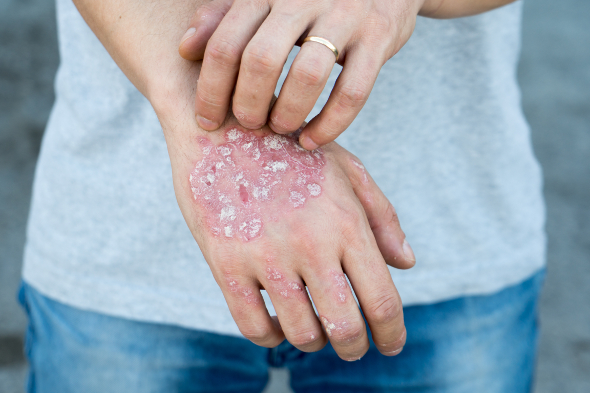 psoriasi