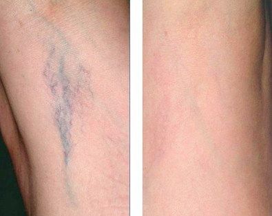 intervento sclerosante