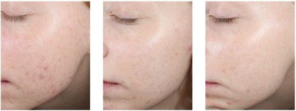 peeling al retinolo